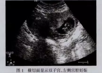 双子宫是怎么怀孕的 双子宫怀孕几率高吗