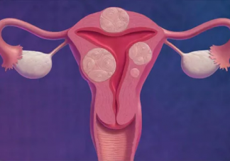 子宫肌瘤怎么预防 子宫肌瘤预防方法
