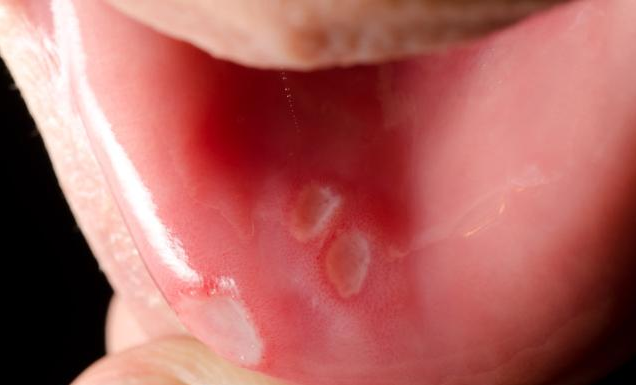 坐月子口腔溃疡怎么办 产后口腔溃疡治疗方法